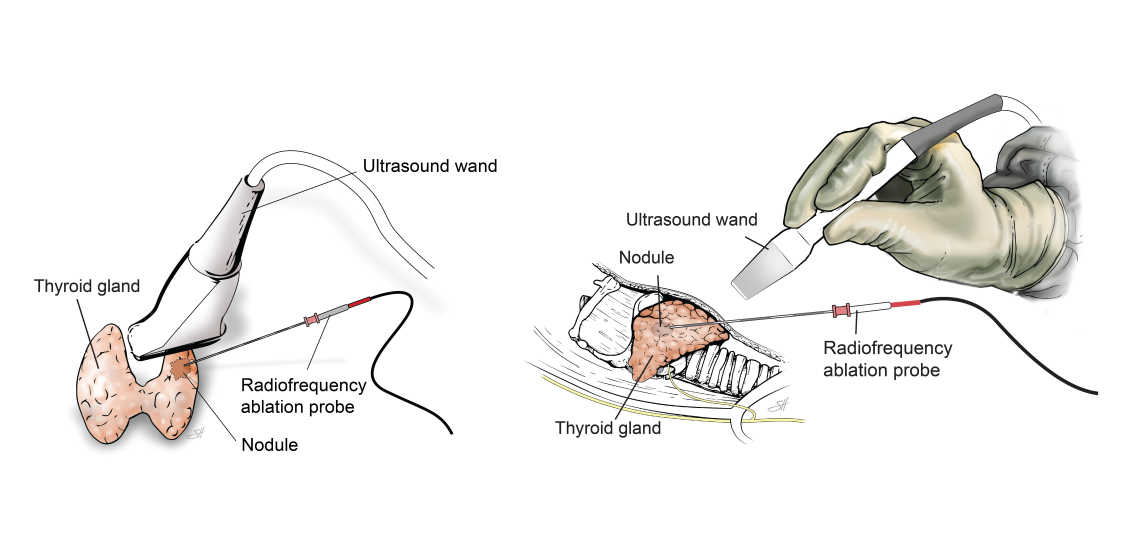 Thyroid Radiofrequency Ablation (RFA) | Baylor Medicine